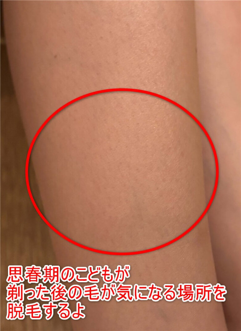 こども 脱毛前 脚