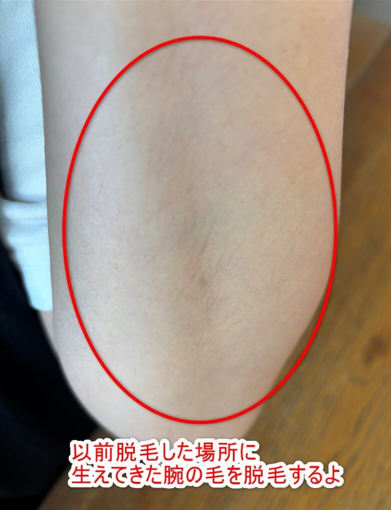 女性 腕脱毛前