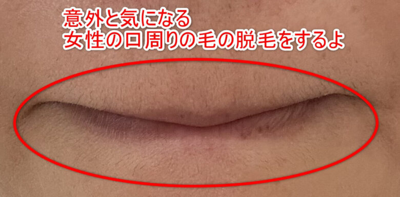 女性 脱毛前 口回り
