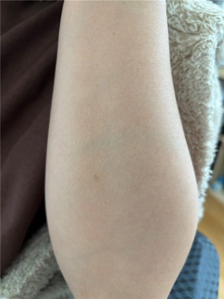 女性 腕脱毛 3回後
