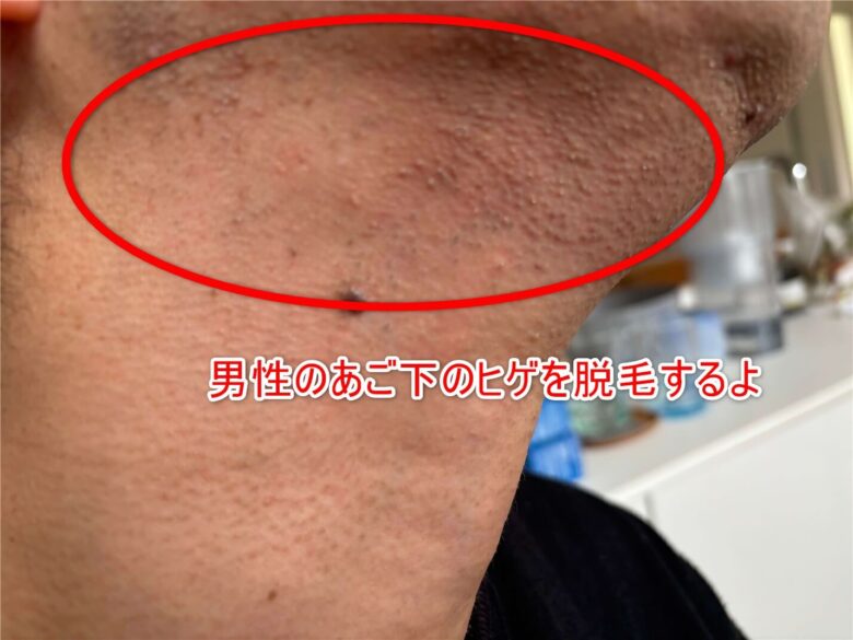 男性 脱毛前 ヒゲ